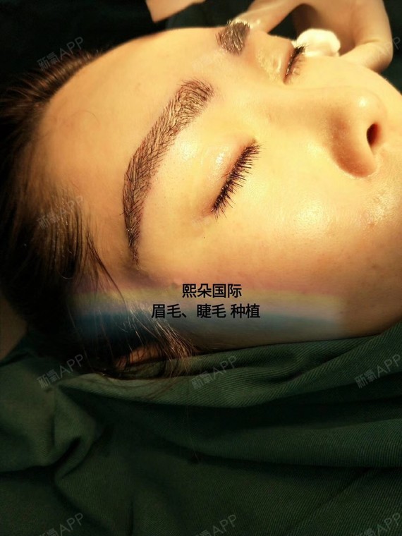 植眉重塑自信，探尋美麗轉(zhuǎn)變之旅的眉毛魅力價格